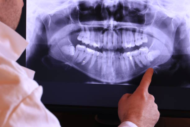 Best Emergency Dentist for Lost Fillings or Crowns in Walnut Grove, CA